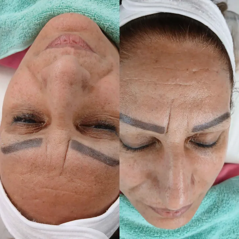 روشن شدن پوست در یک جلسه فیشال