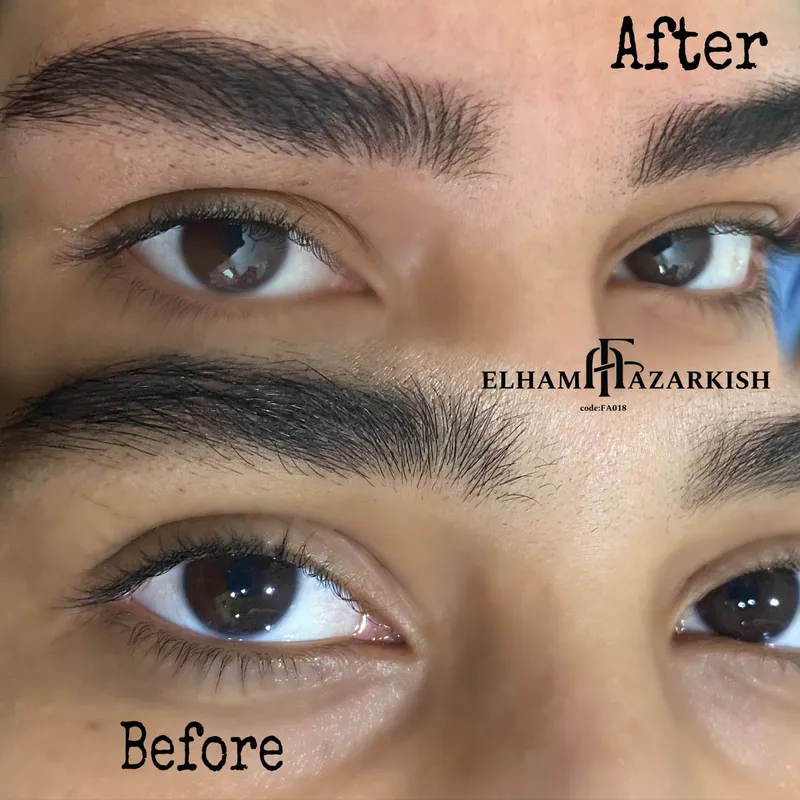 میکروبلیدینگ