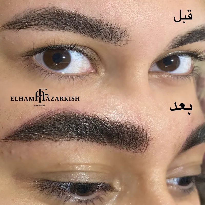 میکروبلیدینگ