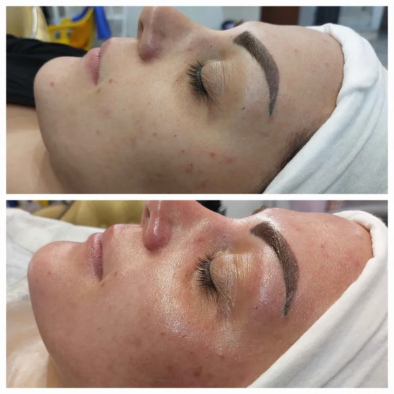 فیشال پاکسازی درمان جوش و جای جوش در اصفهان 