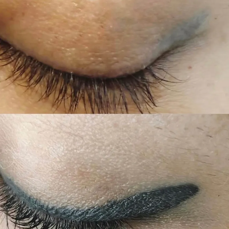 ریموو تتو قدیمی