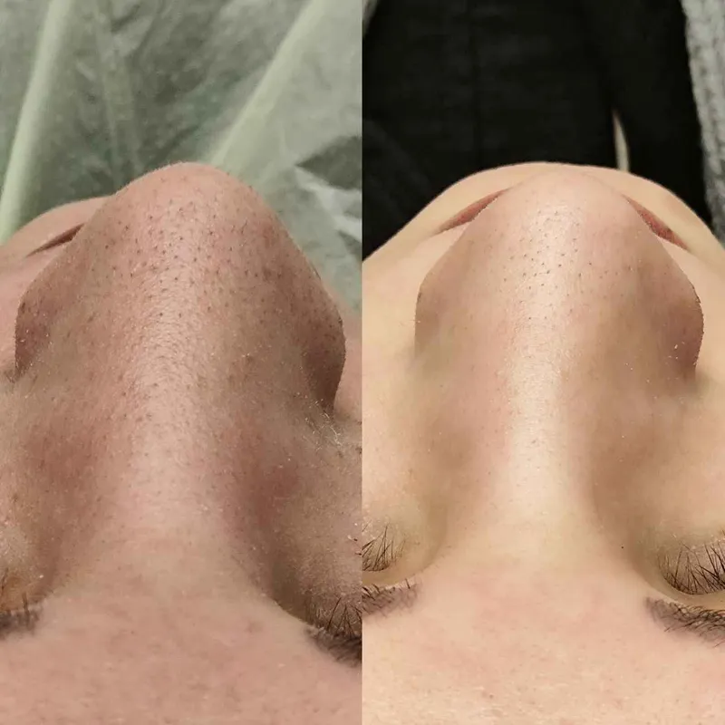 فیشیال پوست