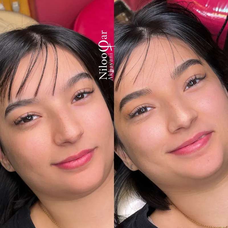 فیبروز ابرو