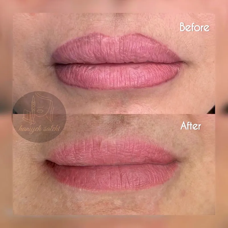 ریموو خط لب