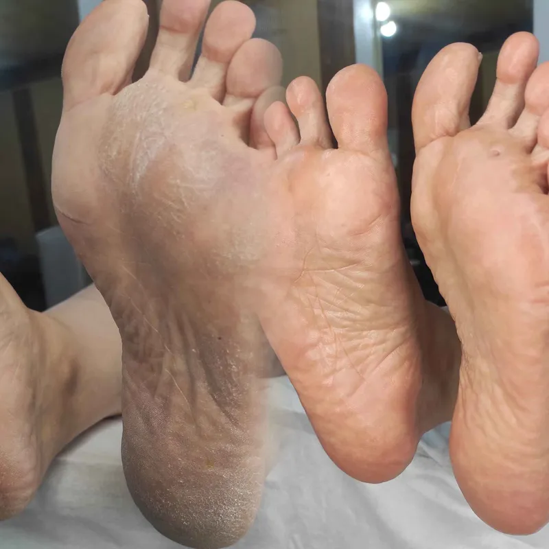 رفع میخچه پا 