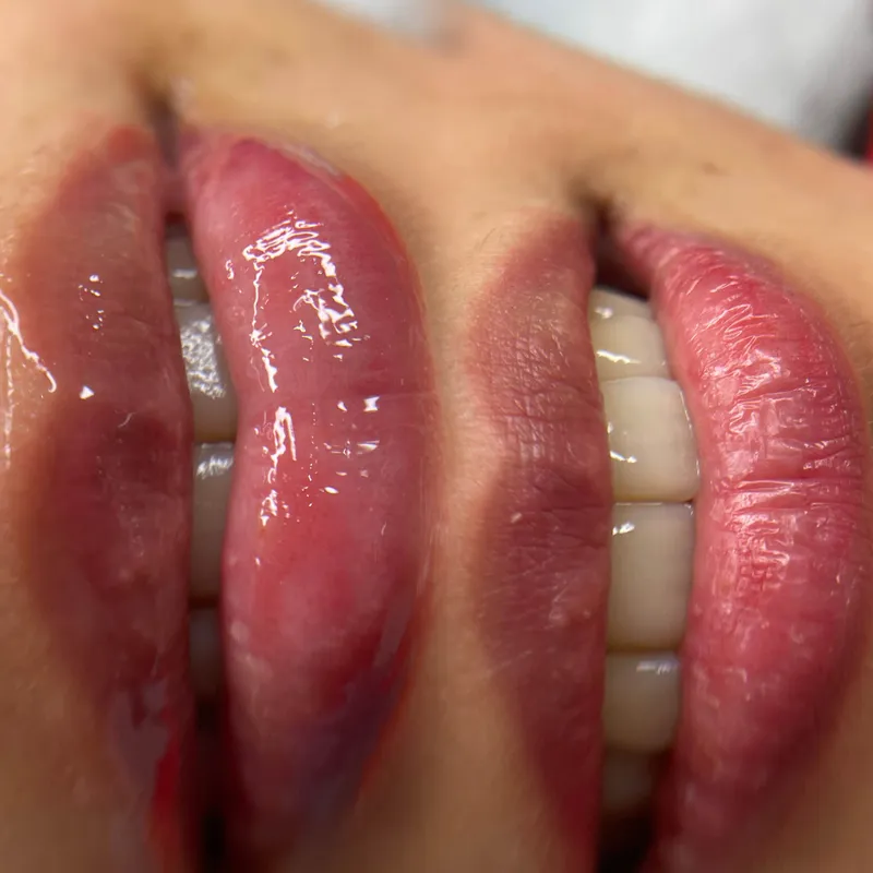 جوانسازی و آبرسانی لب