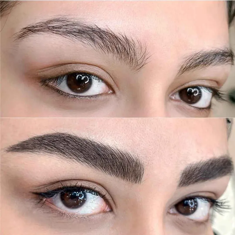 فیبروزومیکروبلیدینگ 