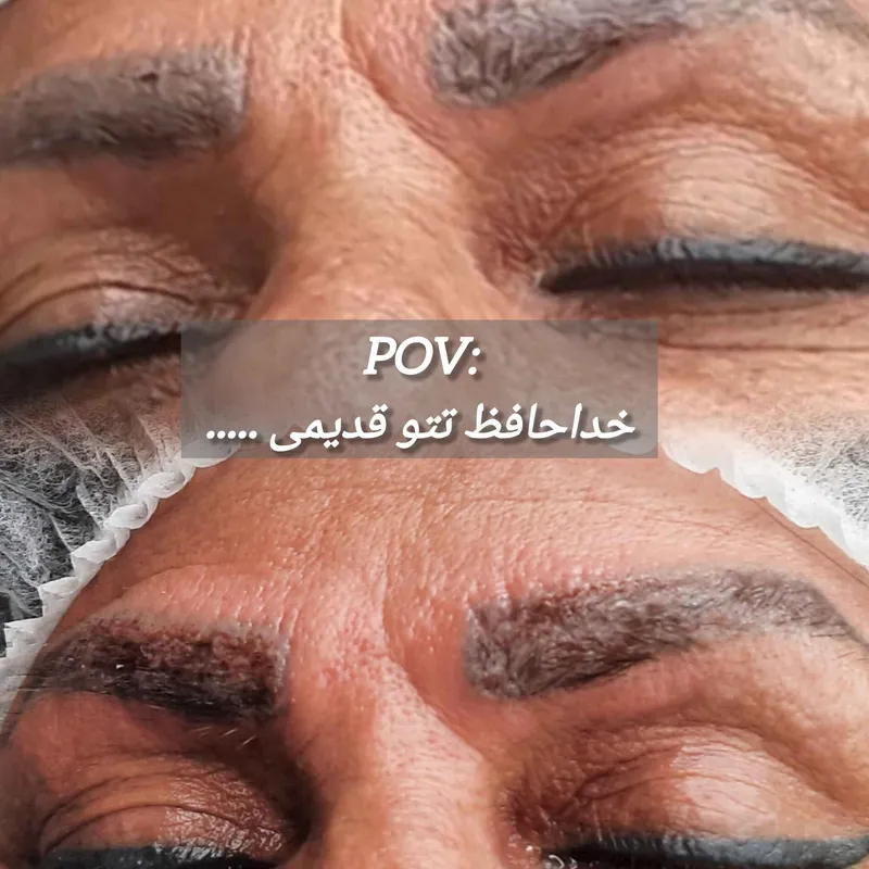 ریمووال ریمو تتو قدیمی