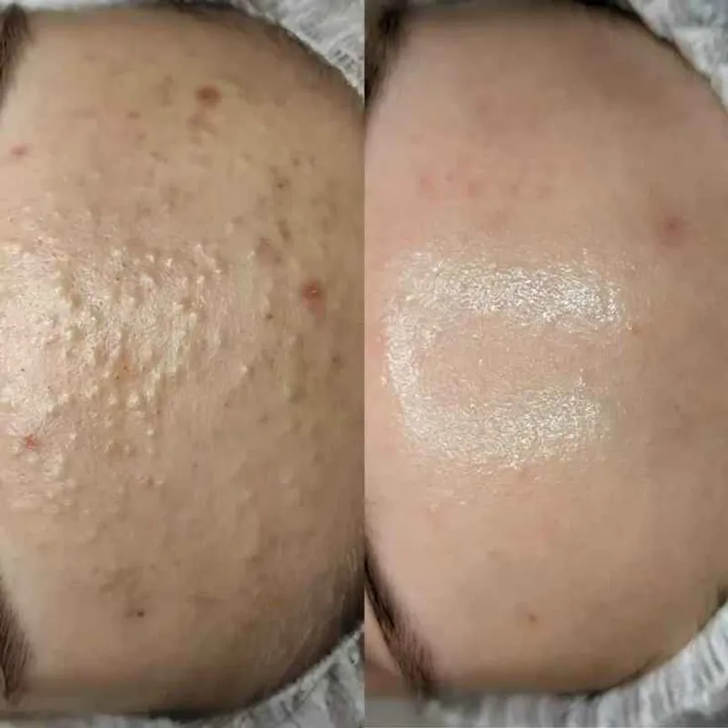 درمان جوش های زیر پوستی