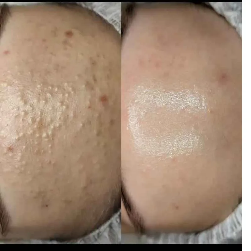 جوش زیر پوستی