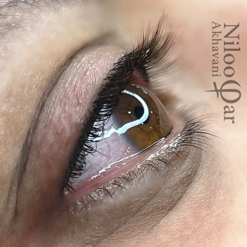 بن مژه نچرال