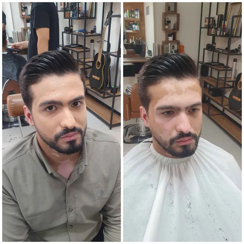 میکاپ صورت آلوپسی 