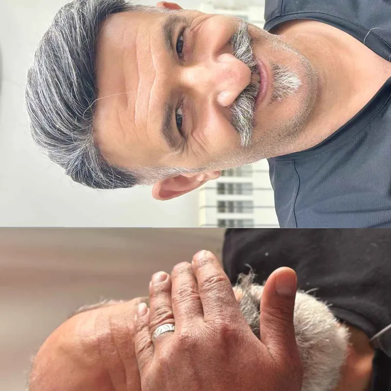 پروتز مو