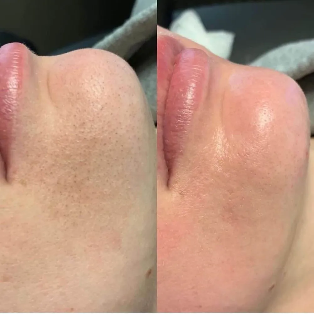 تخلیه جوش سرسیاه و پاکسازی کامل پوست