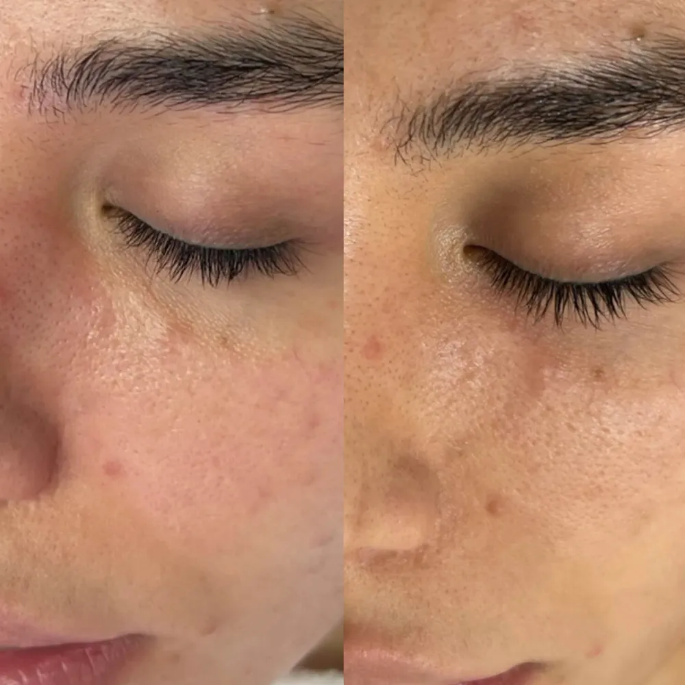 قبل و بعد فیشیال