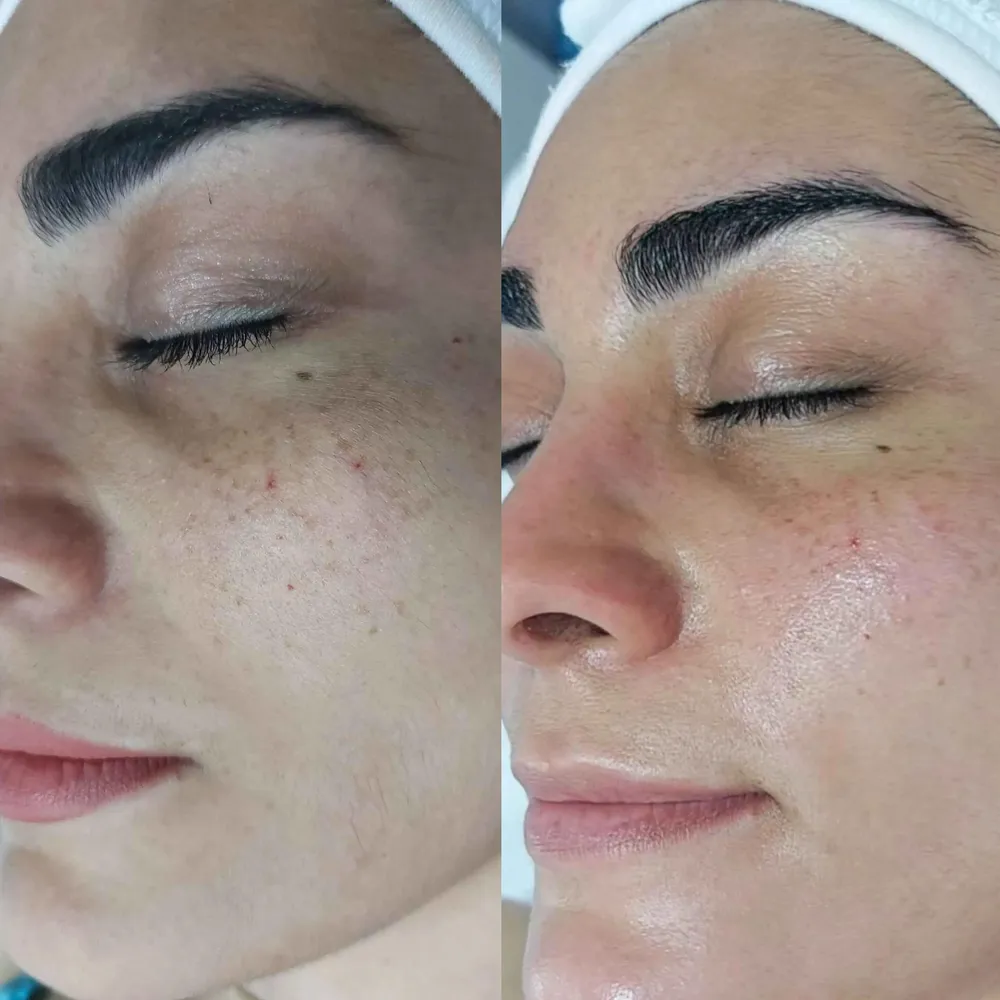 پاکسازی و فیشال پوست خشک و دهیدراته 