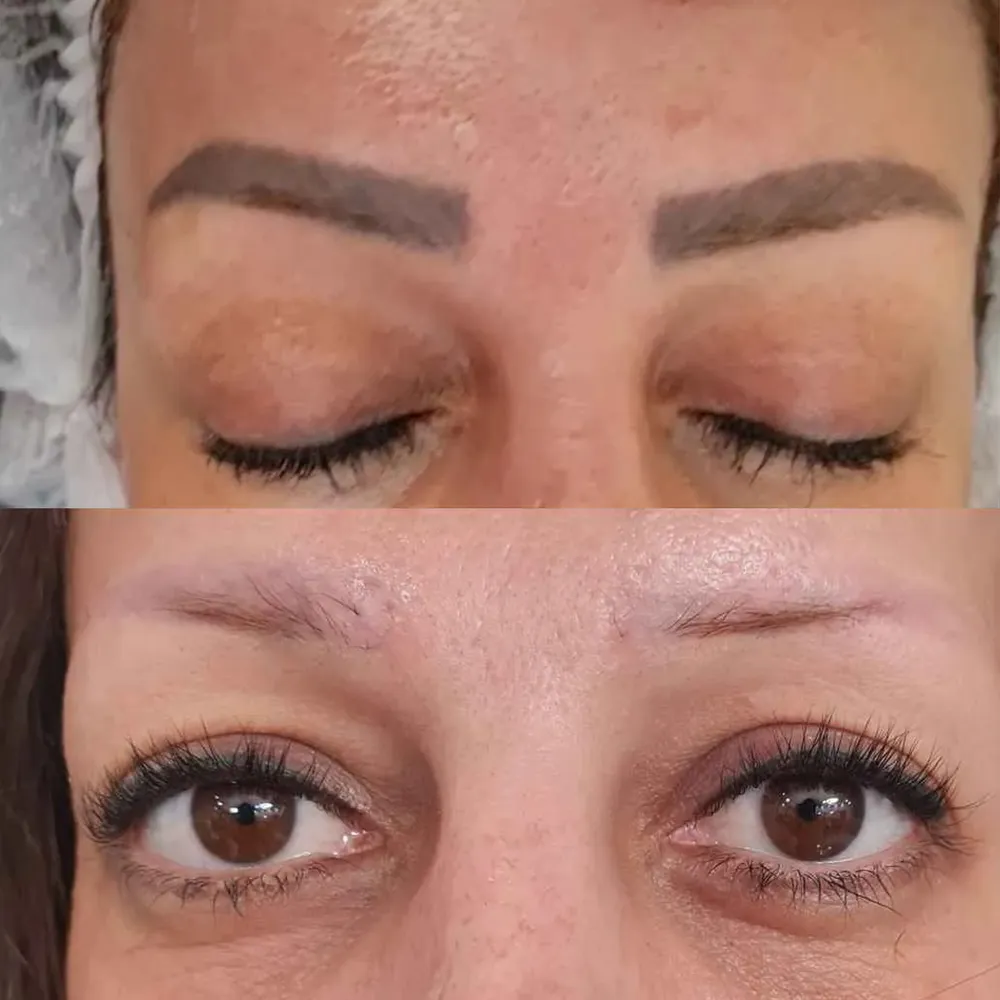 ریموو تتو قدیمی