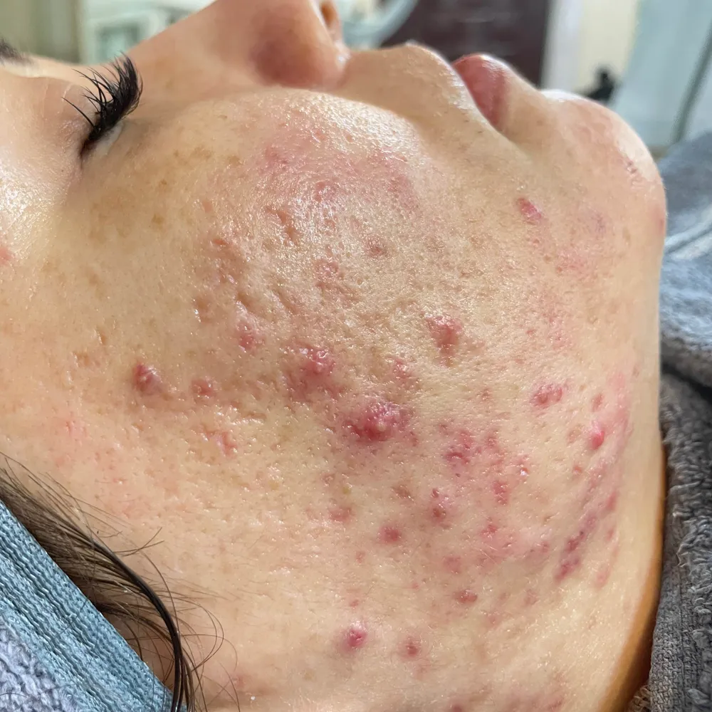 درمان کنترل آکنه التهابی