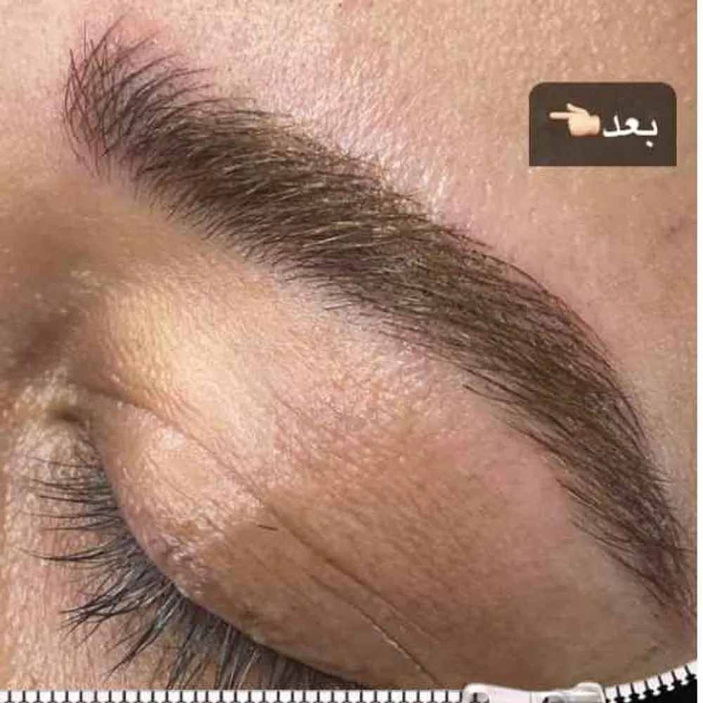 فیبروز هایپر لیفت ابرو  