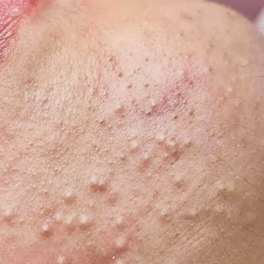 از بین بردن جوش زیر پوستی و سرسفید 