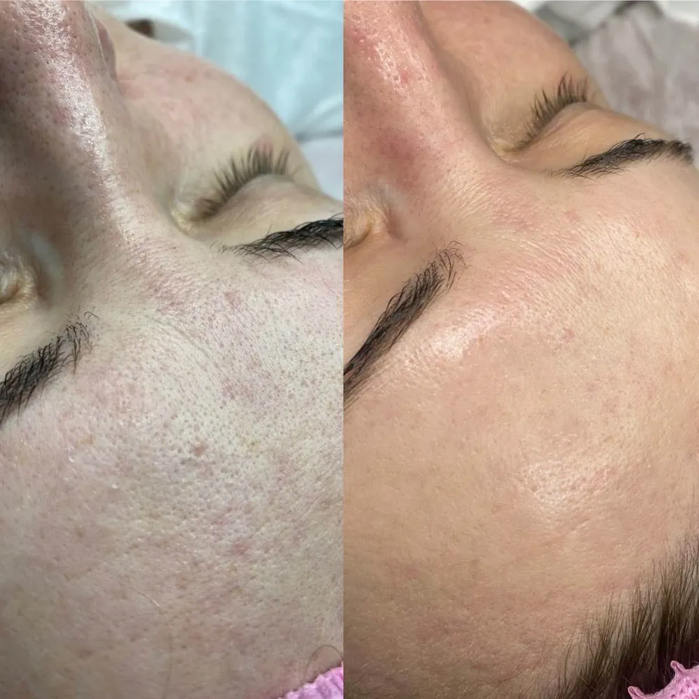 فیشال و پاکسازی صورت