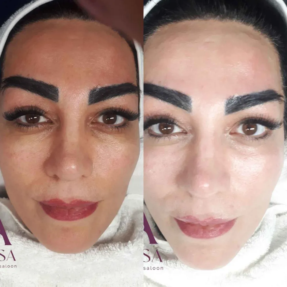 قبل و بعد از فیشال