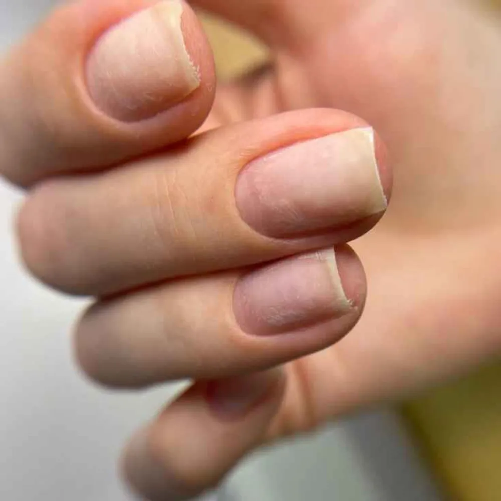 کاشت پلی ژل