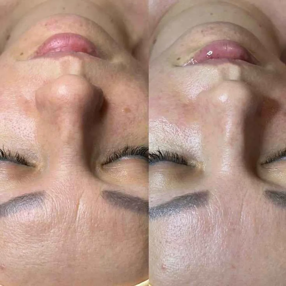 قبل وبعدکربوکسی تراپی