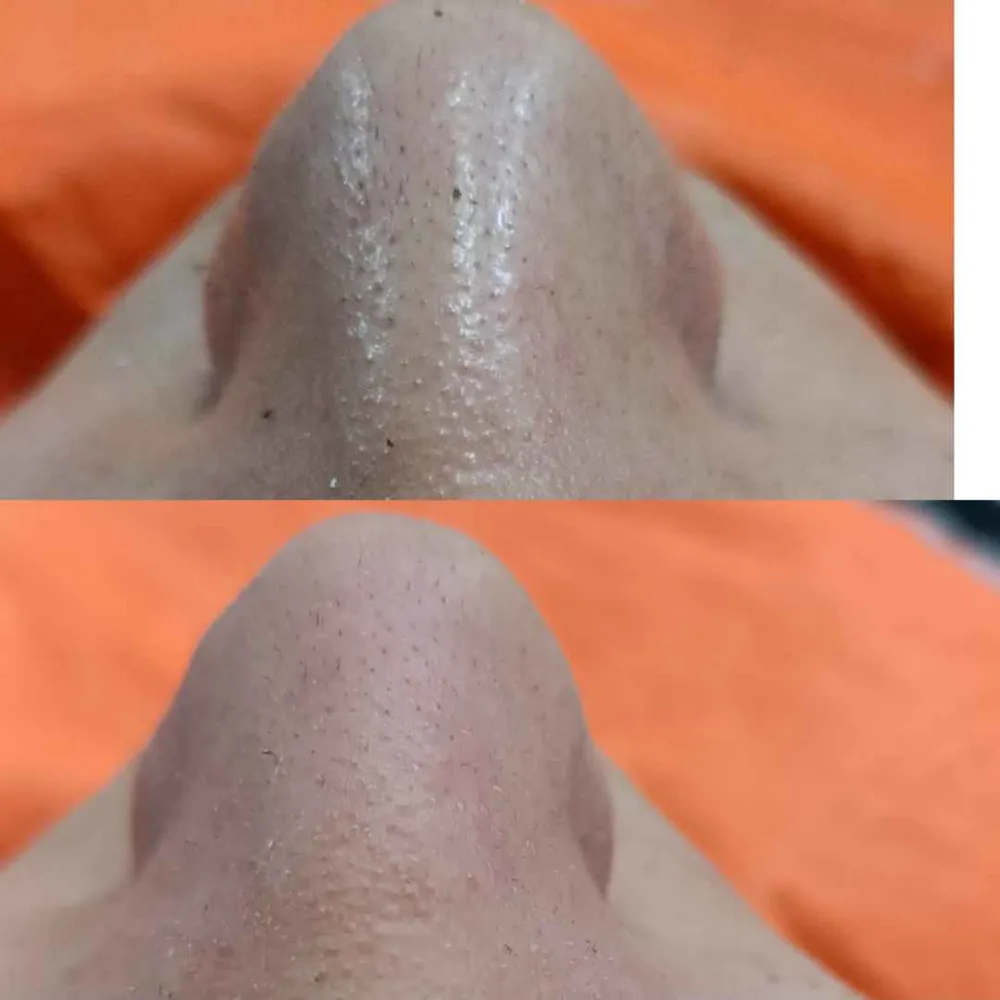 درمان جوش سرسیاه