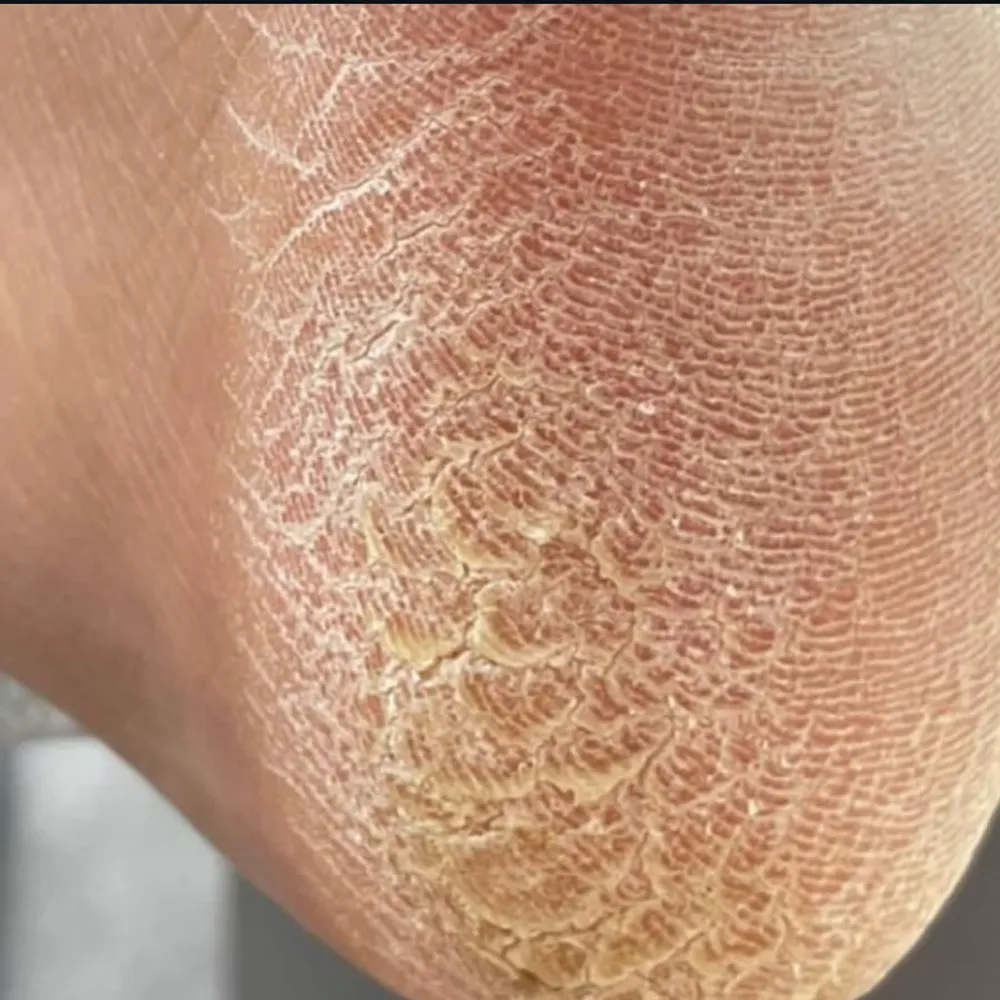 پدیکورکفسابی درمانی