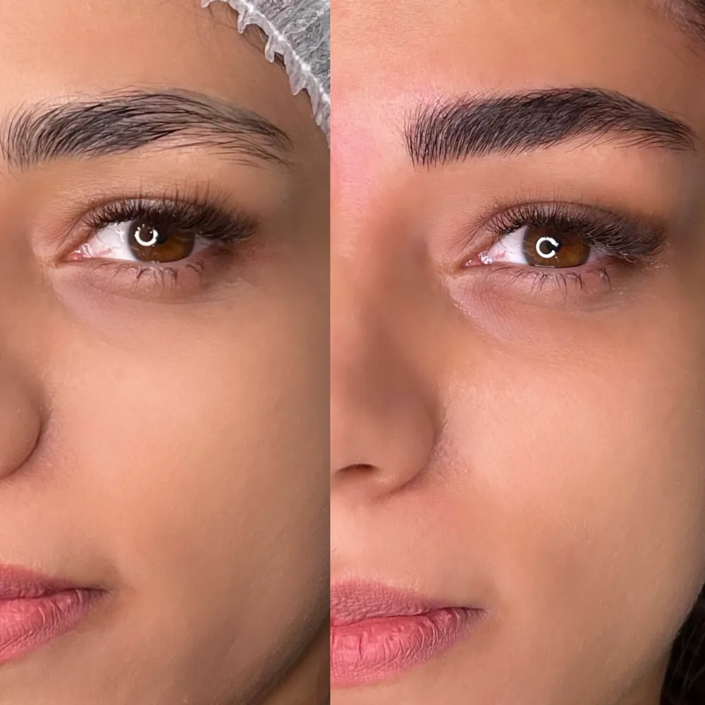 میکروبلیدینگ دخترونه