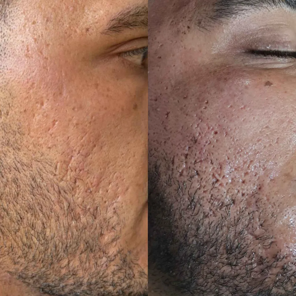 لاین درمان اسکار و شفافیت پوست جلسه اول ...درمان ادامه دارد ...