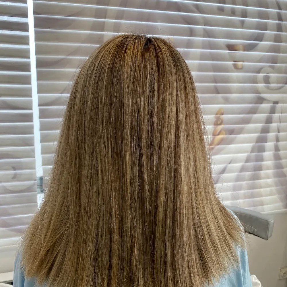 بوتاکس تراپی 