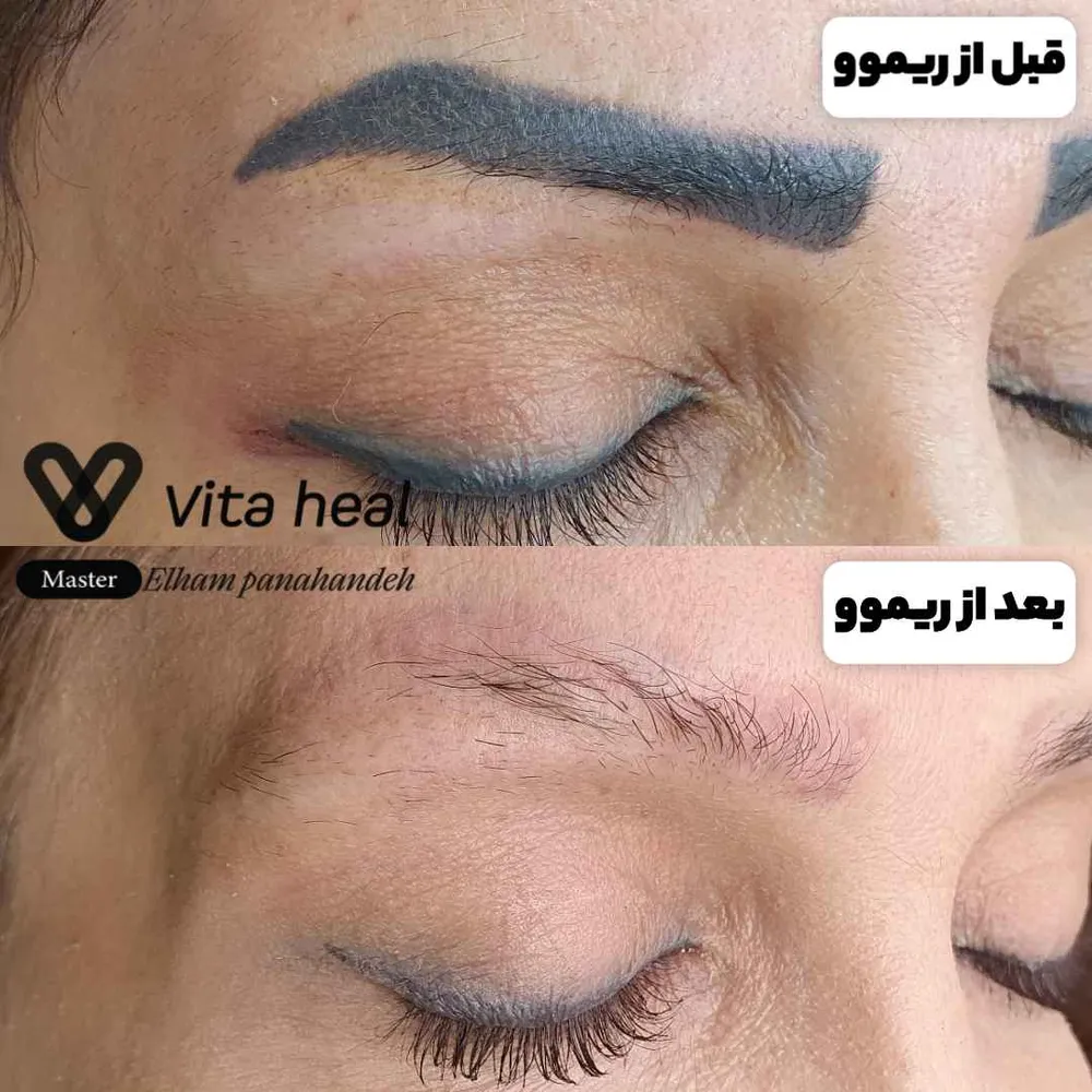 ریموو میکرو