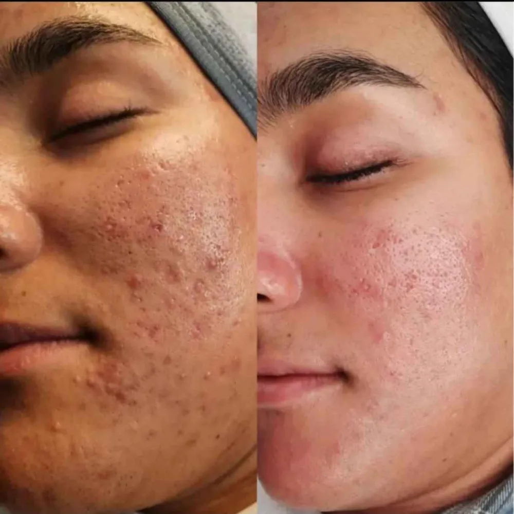 پاکسازی جوش صورت 