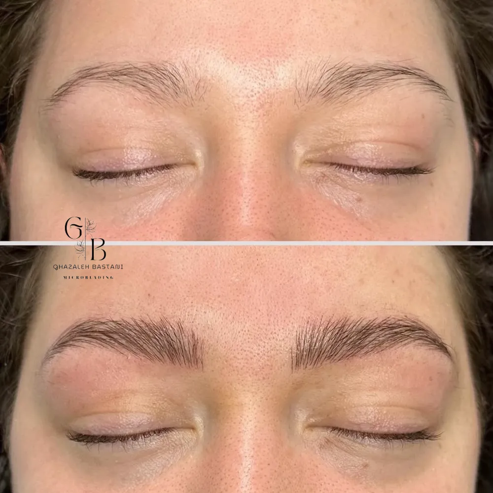 ميكروبليدينگ تكنيك موريروز