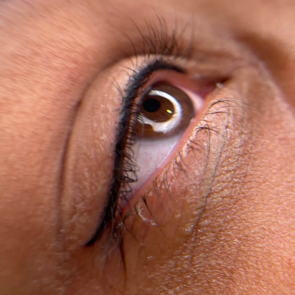 میکروپیگمنتیشن چشم