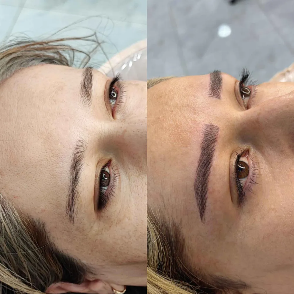 میکروبلیدینگ فیبروز