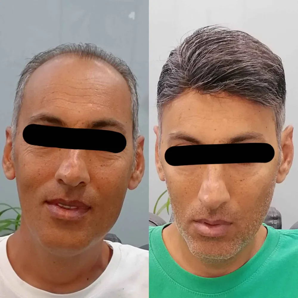 پروتز طبیعی مو