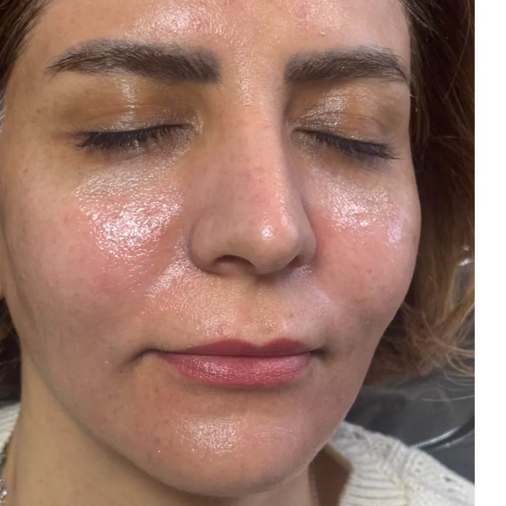 پیلینگ صورت