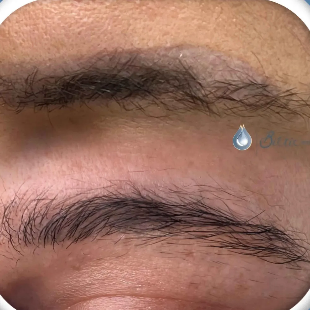 ریموو تتو قدیمی