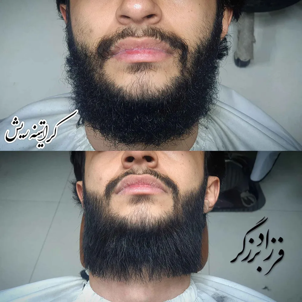 کراتینه ریش 