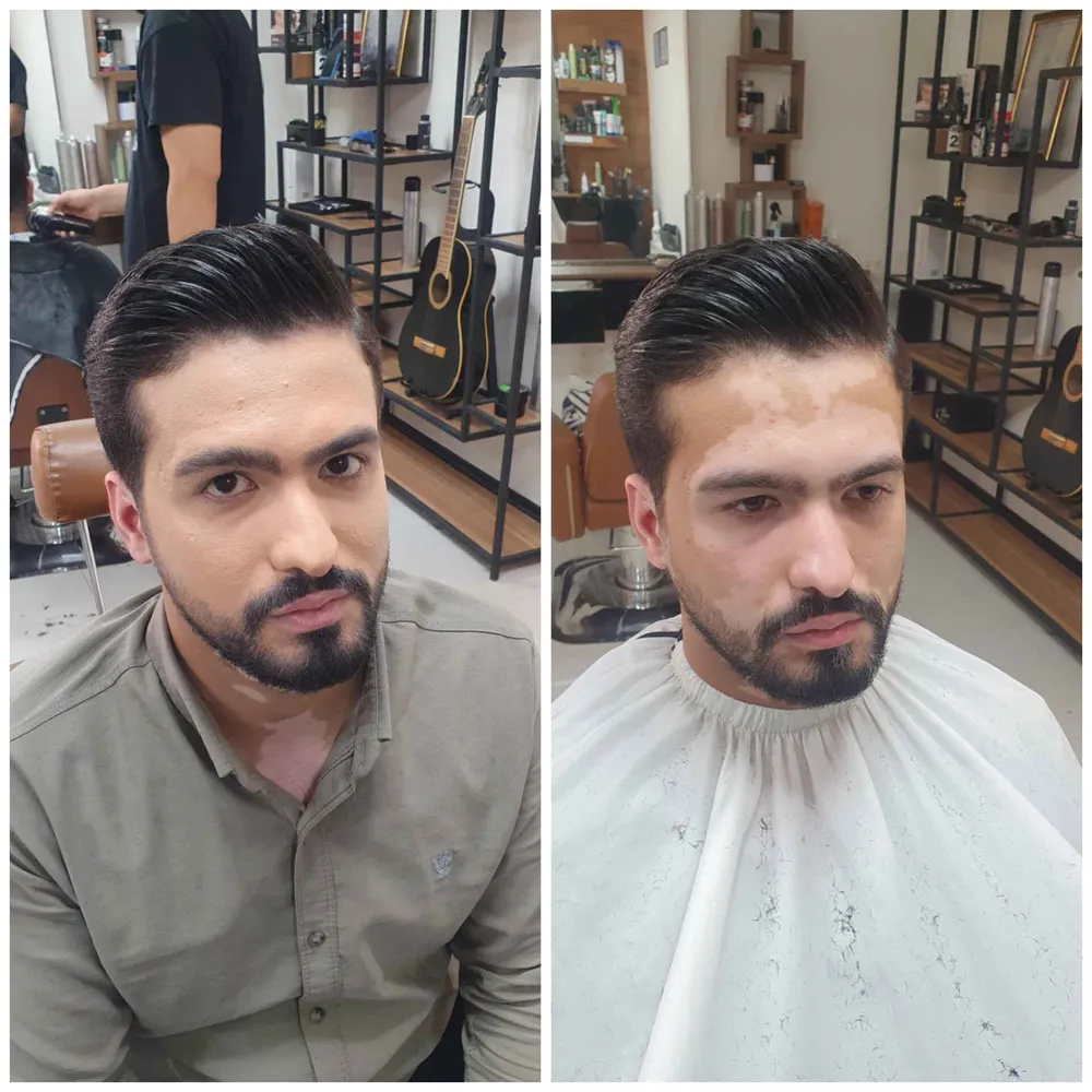 میکاپ صورت آلوپسی 