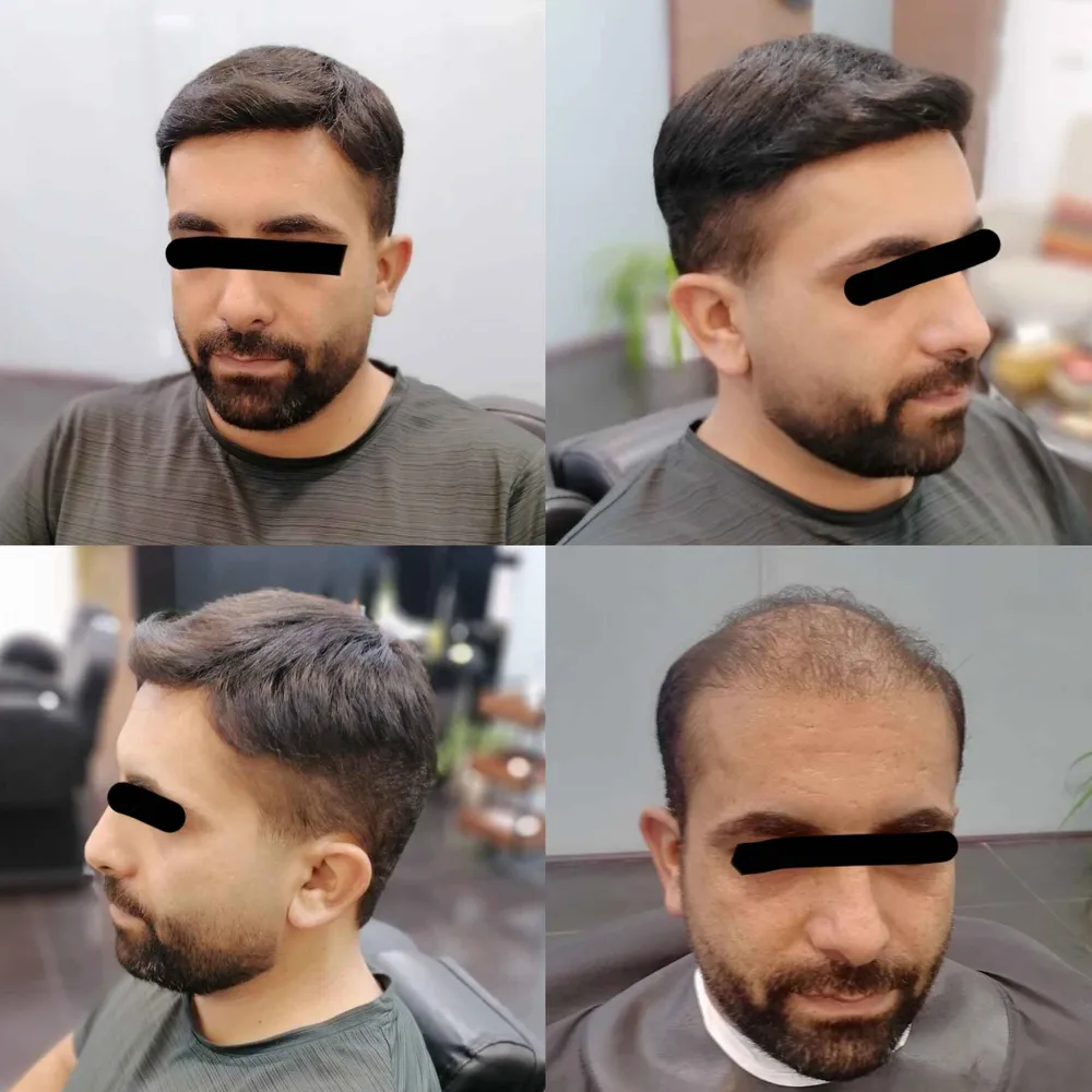 پروتز مو