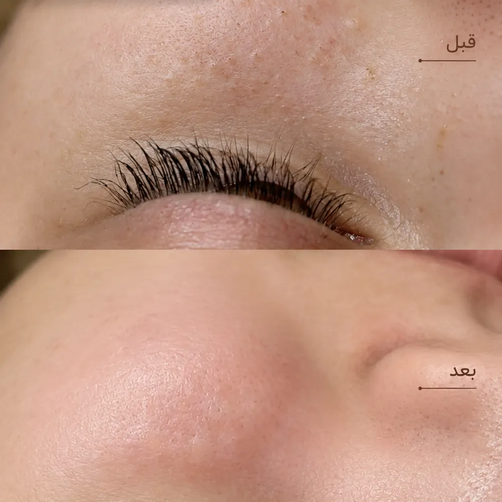 تخلیه منافذ،آبرسانی پوست گالوانیک