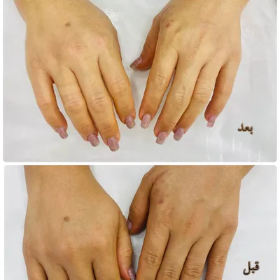جوانسازی و روشن سازی پوست دست ها 